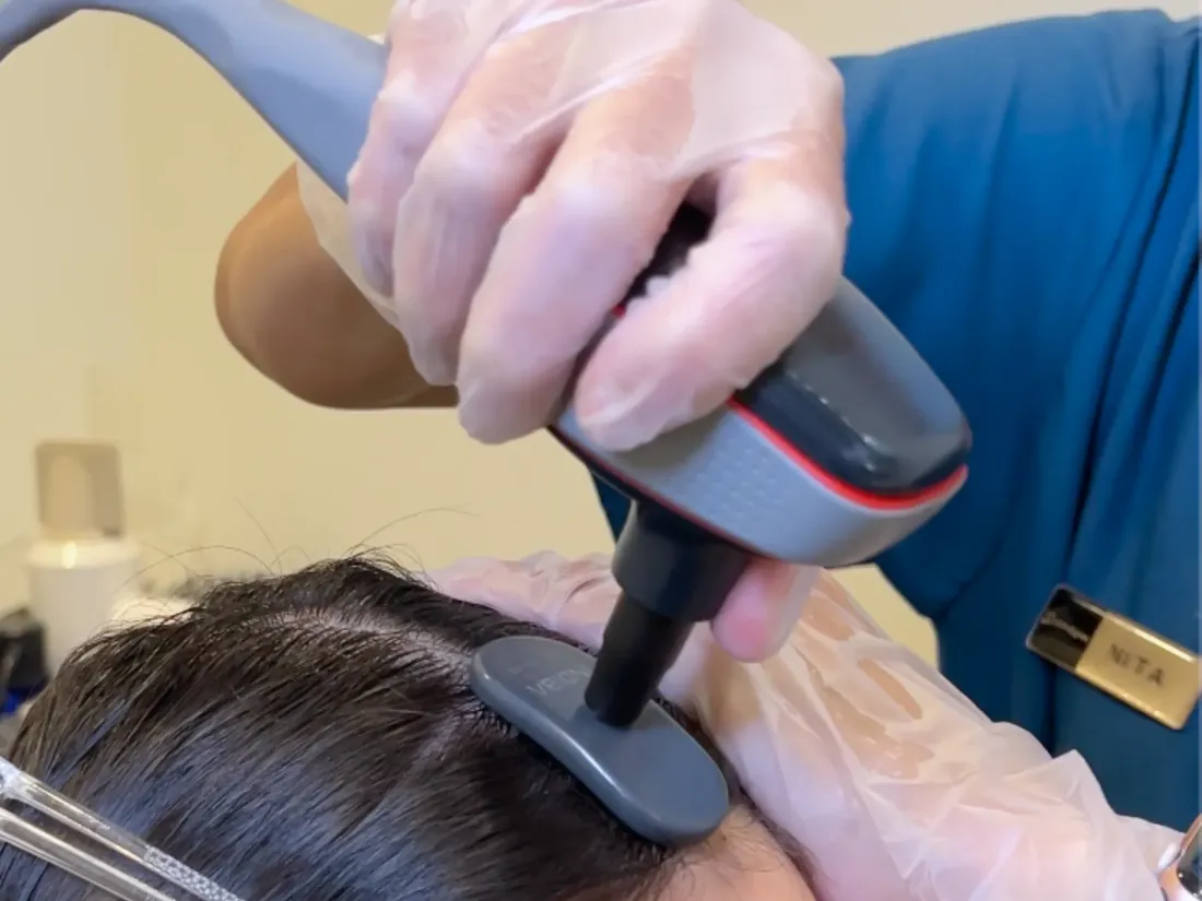 Indiba radio frequency therapy stimulating circulation and hair follicle activity