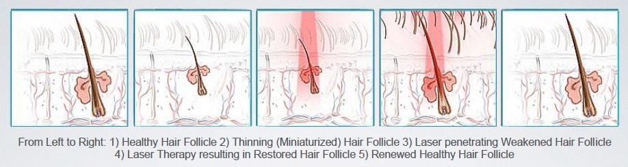 Hair follicle renewal with Cap-ls therapy